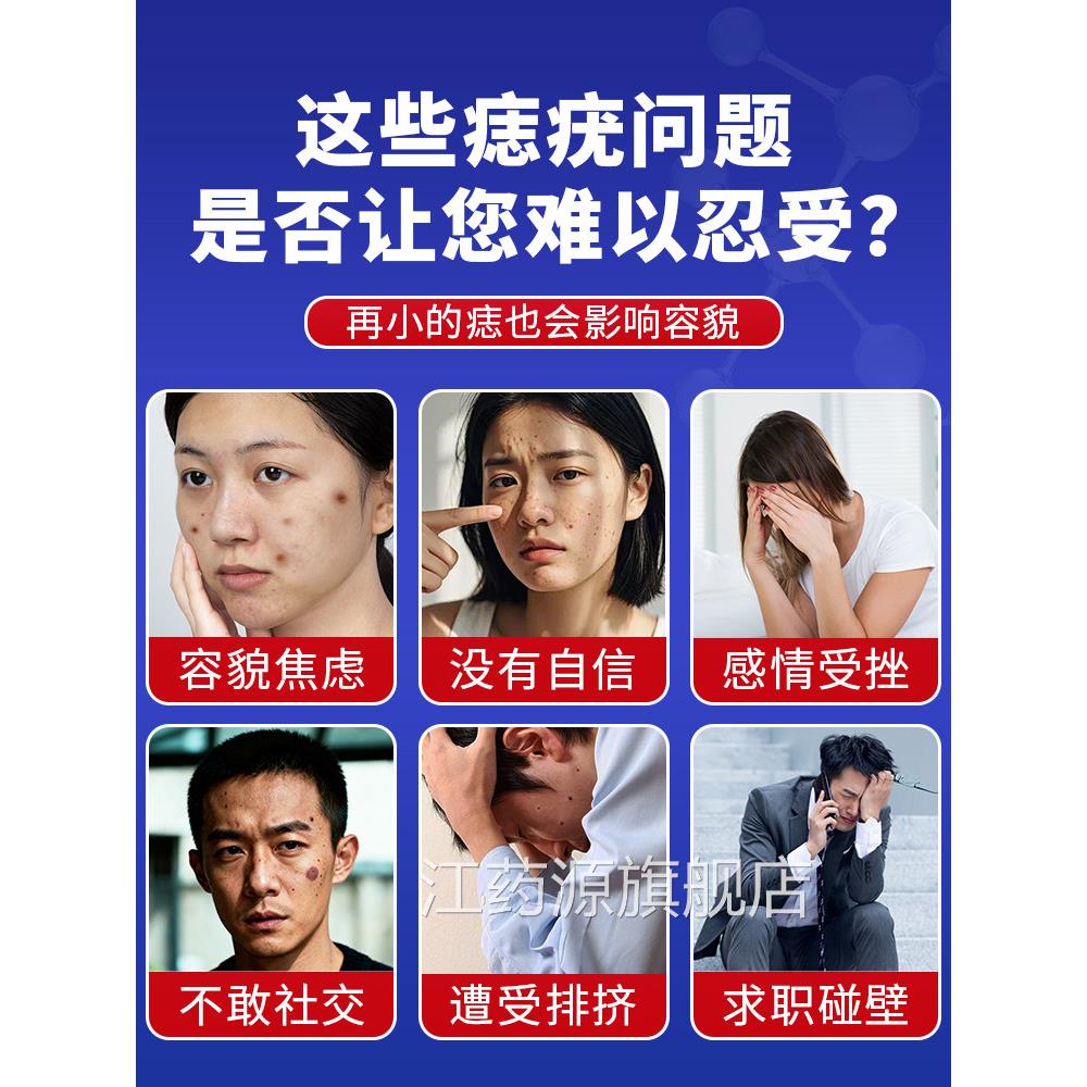 点痣膏正品点痣水无留痕神器不疤修复液祛去痣官方大药房旗舰店nj