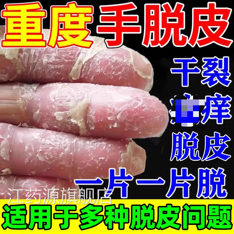 手足脱皮膏手严重脱皮专真菌蜕皮干用燥起皮感染季节性儿童手脱皮