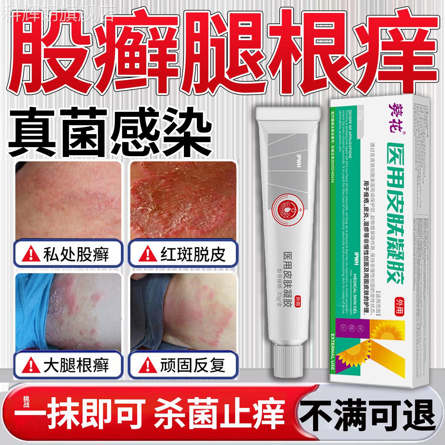 大腿内侧肤瘙痒股藓癣止痒去男士专根用治疗私处真菌感染皮潮湿E