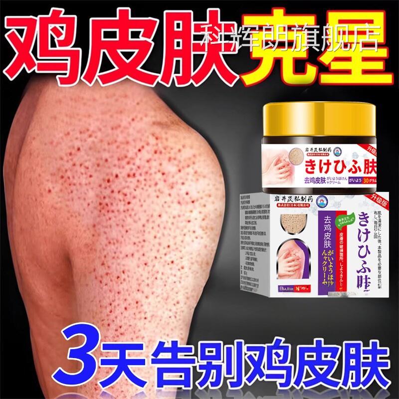 日本去鸡皮肤鱼鳞疙瘩毛囊角化角质膏用手臂身体去除症器永科辉朗