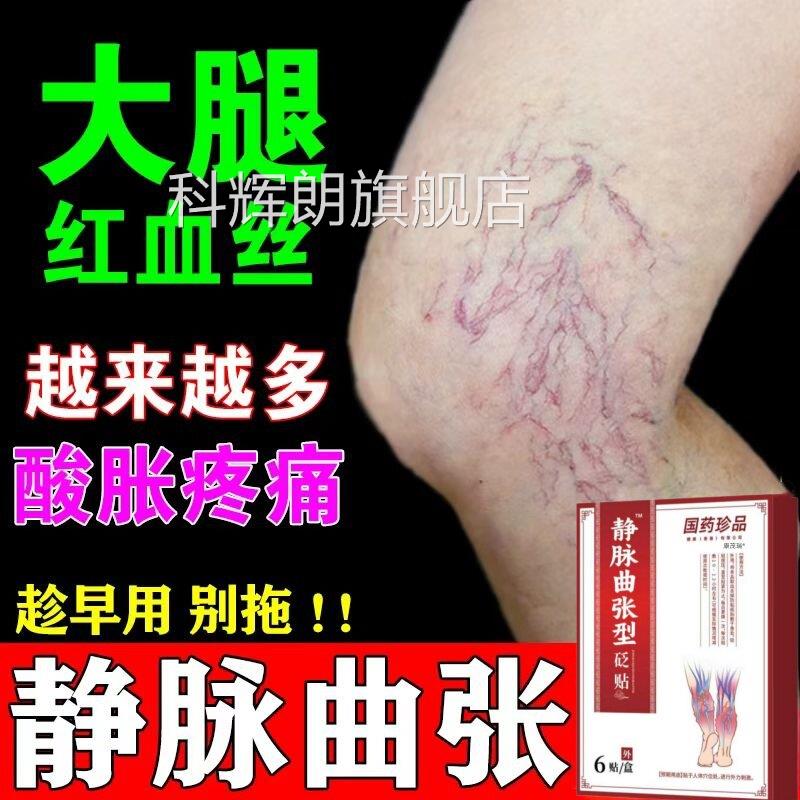静脉曲部张膏药贴冷敷凝胶正品专用腿青筋凸起烂腿红血丝静脉扩张