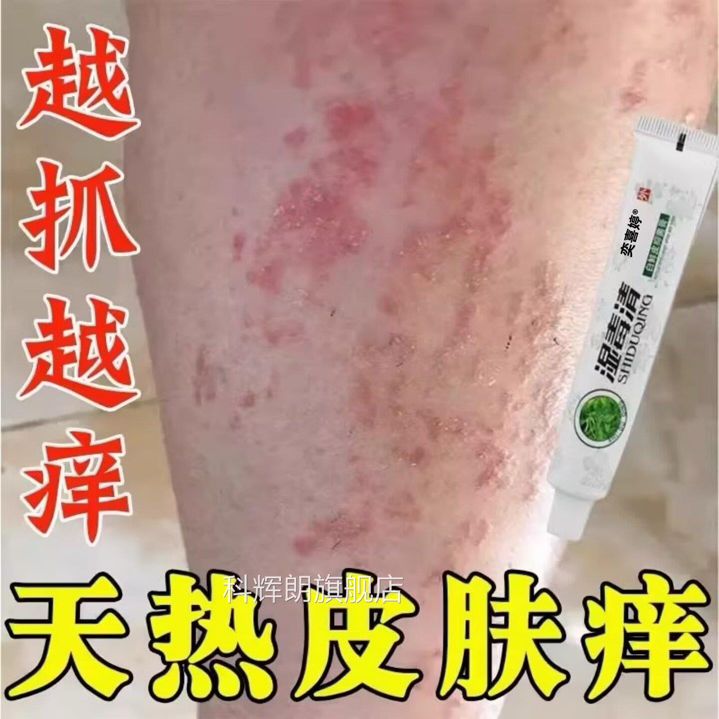 夏天小痒湿成人止膏出汗身上痒腿天热皮肤疹瘙痒热疙瘩红疹热毒痒