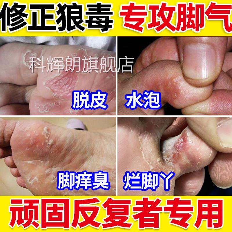 脚脱皮止痒杀菌气脚痒水泡去脚趾缝烂脚专丫根神器狼毒膏喷雾用科