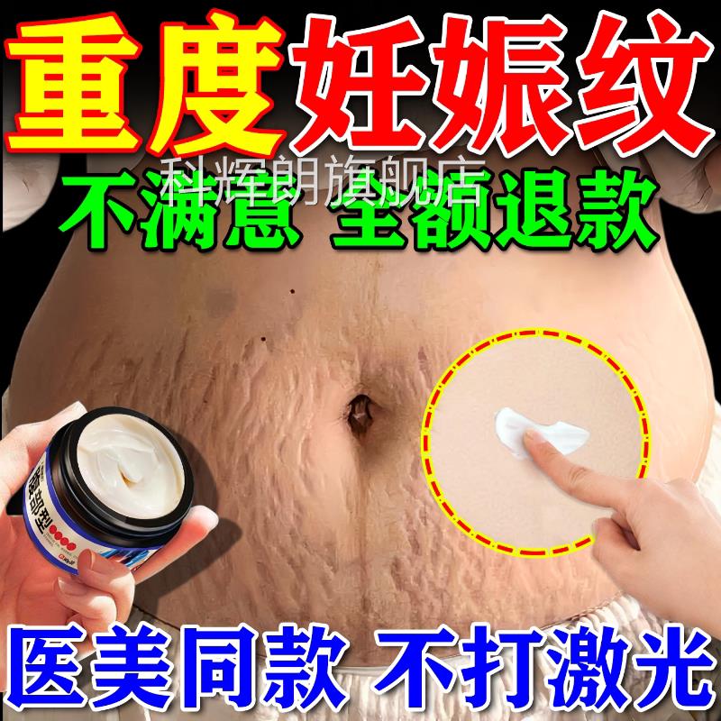 妊辰纹消除去妊娠纹非盖紧致肚皮非修复霜非淡化除疤痕膏遮神器科