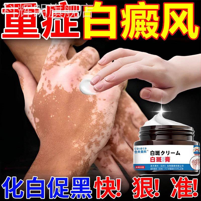 白癜风外用黑色素生长快速消白斑专用汗斑遮神盖器白斑净白斑克星