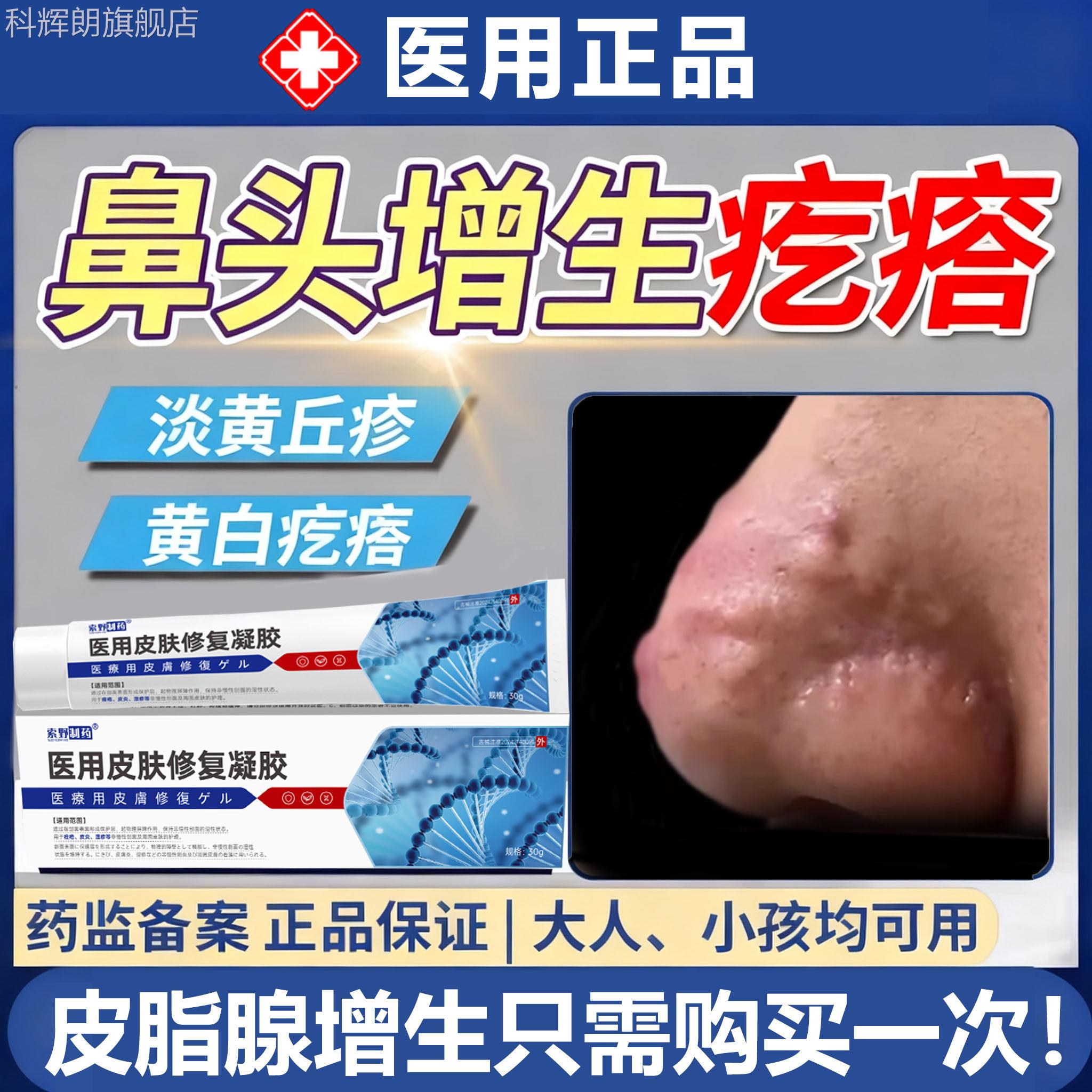 面部鼻子鼻翼上肉疙瘩皮脂腺增生异赘位症鼻小颗粒丘疹去除药膏TK