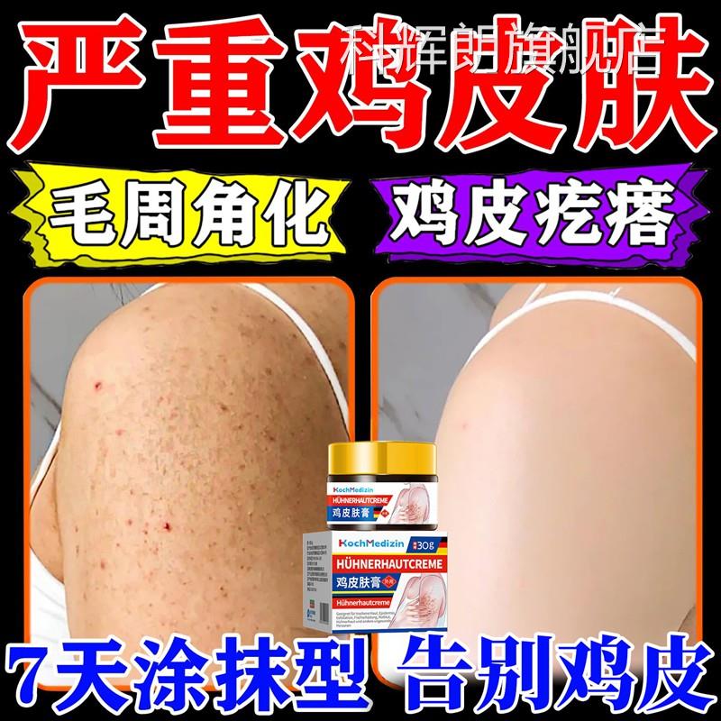 去鸡皮肤疙瘩药毛囊角化角质症专去除膏全身手臂腿鳞用神鱼器儿童