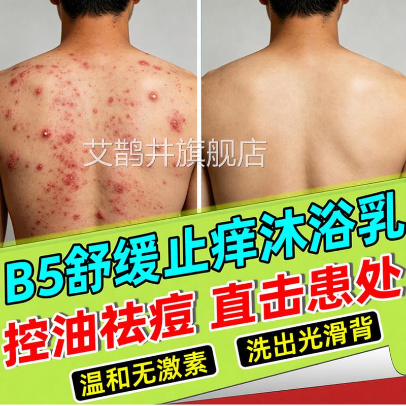 马拉色菌前胸后背部祛痘过氧化甲酰洗苯液粉末黑印沐浴露溶剂控油