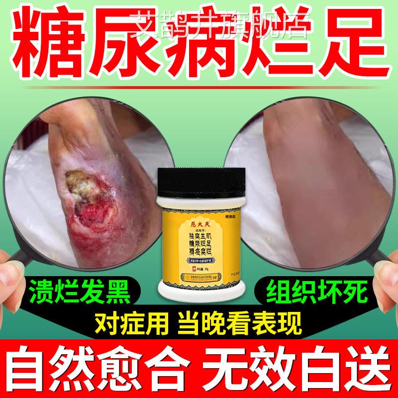 糖尿病烂足专用药膏伤愈合促口进长肉烂脚祛腐生肌皮肤溃烂药膏T1