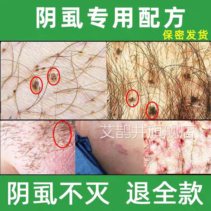 阴虱专用药一扫光正品旗舰店敌百虫片人阴用虱子阴毛虫治虱药喷剂
