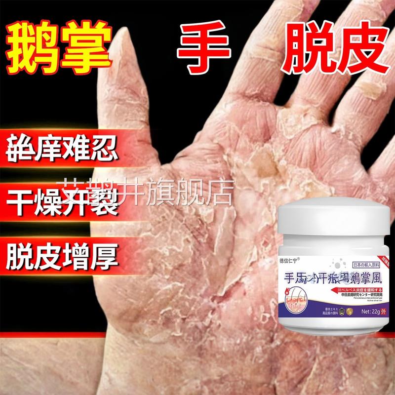 鹅掌风手膏脱皮干裂真菌感染角化型湿去手用部角化皲裂膏艾鹊井旗