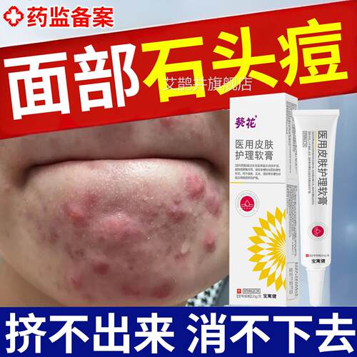 祛石头痘肿下巴反复长痘痤疮皮脂腺结节硬块痘痘去红肿囊脓包药膏
