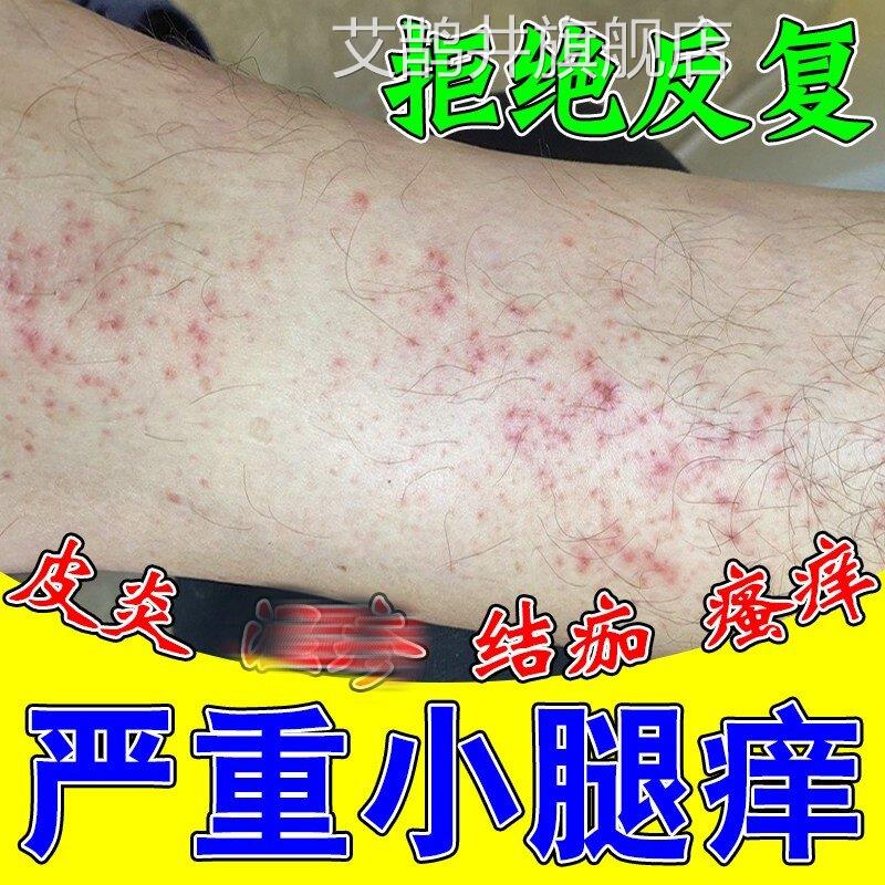 夏小腿痒湿成人止膏出汗身上痒天热天皮肤疹瘙痒热疙瘩红疹热毒痒