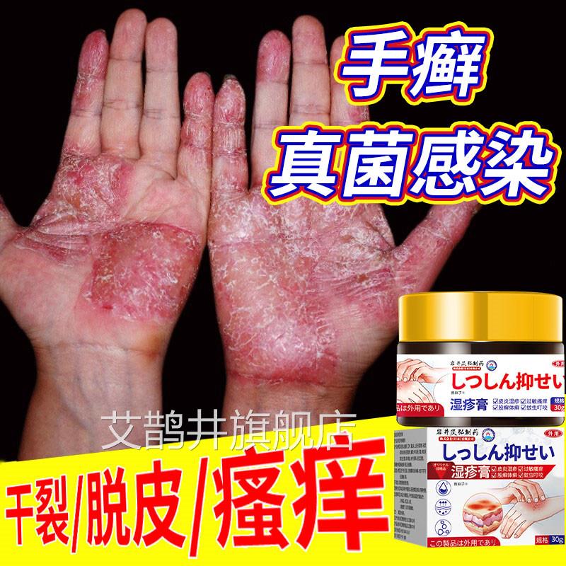 角化型湿疹手干癣膏脱皮裂去真菌感染根外用顽固皮炎手足癣专用膏