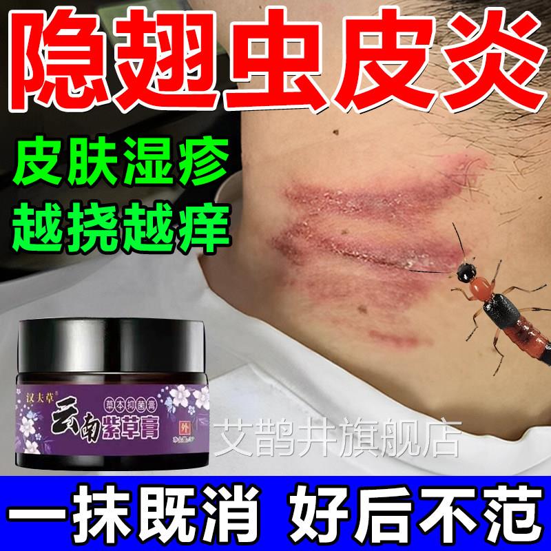 隐翅虫药膏皮肤炎红火蚁蚊子臭虫叮咬蚂伤水疱瘙痒祛疤止痒外用膏