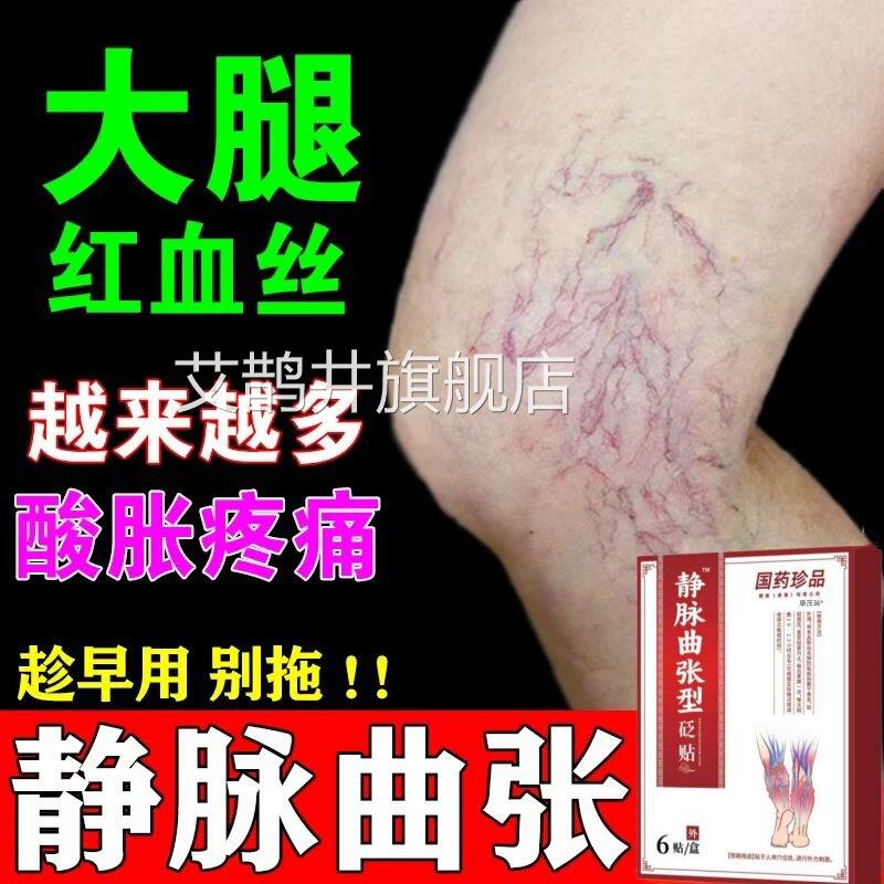 静脉曲张膏药贴冷敷凝胶正品用腿部青筋专凸起烂腿红血丝静脉扩张