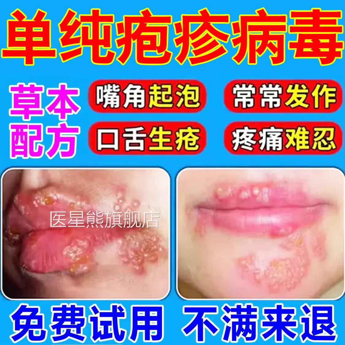 嘴唇单纯疱疹药膏口唇嘴上火起泡烂嘴角水泡巴开裂药口角炎病毒医