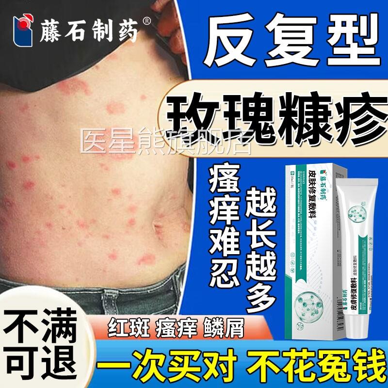 玫瑰糠疹皮肤痒红斑专用皮炎去湿疹紫外线真菌乳软膏瘙药房同售CA