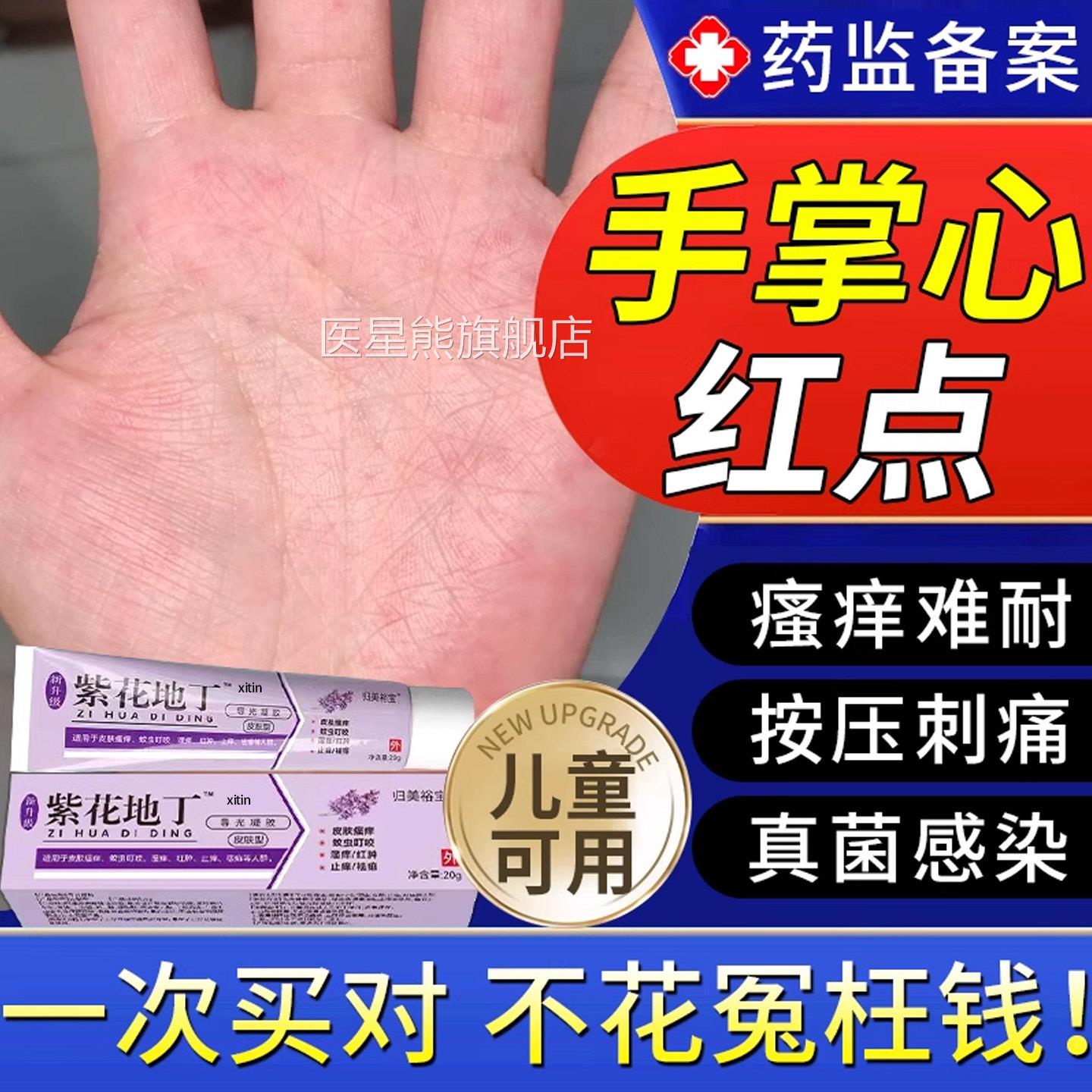 手心掌红点瘙痒脱皮湿疹专用除湿止痒真菌感手染手气水泡汗疱疹TT