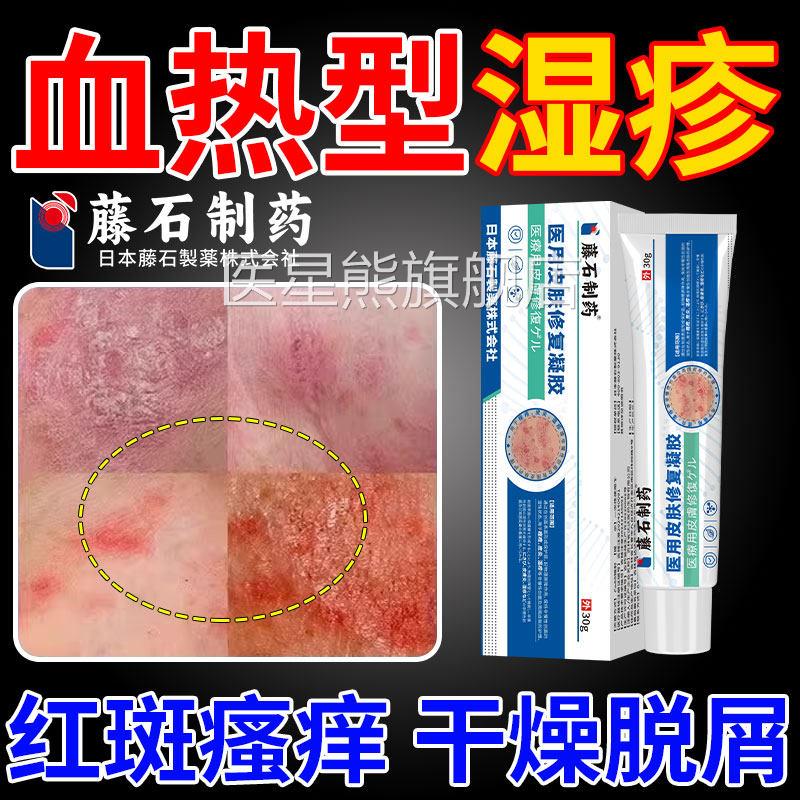 皮肤血热性热毒湿疹止痒膏去湿根瘙顽固皮炎真菌感染专用皮肤痒CA