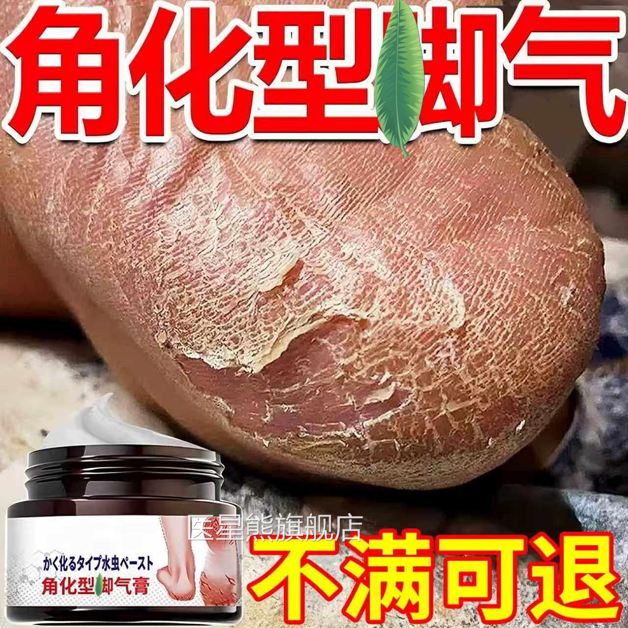 日本角化型脚i气脚后跟干裂开裂脱皮专用特杀菌真止菌感染根效痒