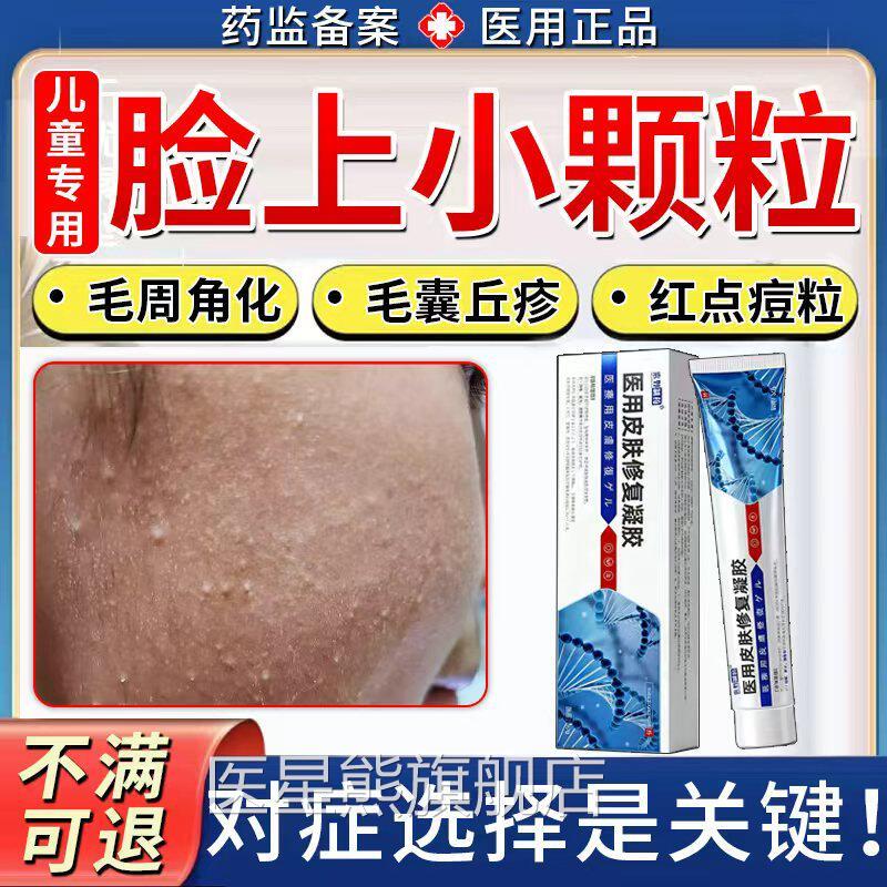 儿童脸周上有小颗粒面部毛角化鸡皮肤疙瘩毛囊角化毛囊炎去除TK医
