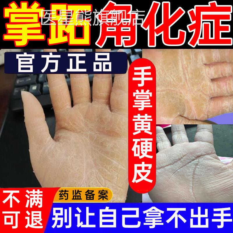 掌跖角化症掌趾脓包膏手心发黄增裂厚硬皮角化型湿疹脱皮干喷剂PP