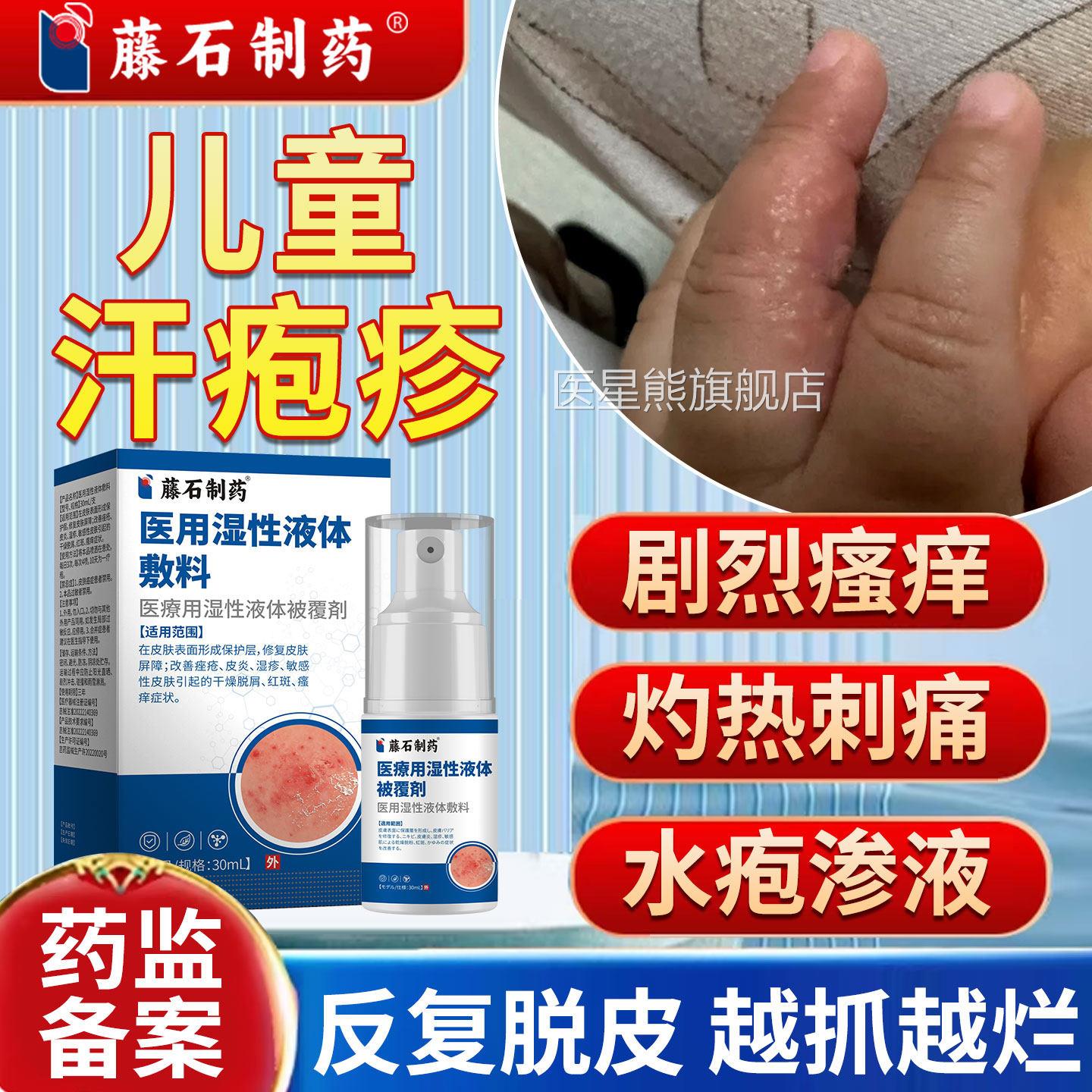 儿汗泡汗状疱疹手童上起小水泡止痒根去专用脱皮药房同售软育YI医