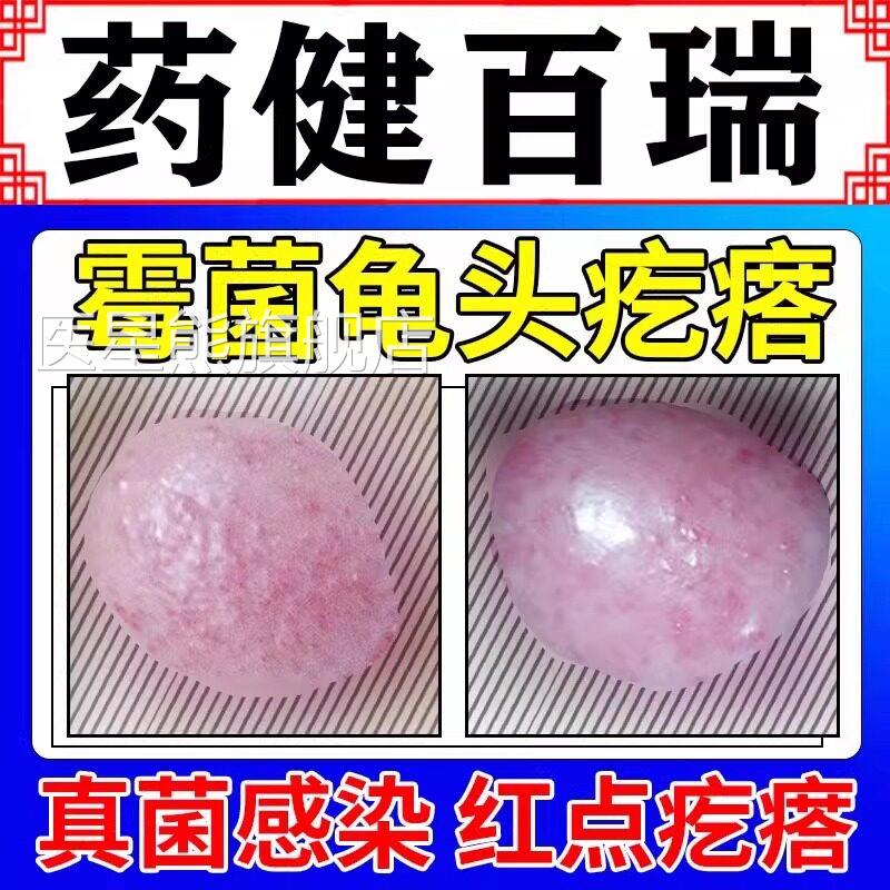 男染性龟头炎真菌感霉菌型症专用念珠菌性上有小红点疙瘩小颗粒GX