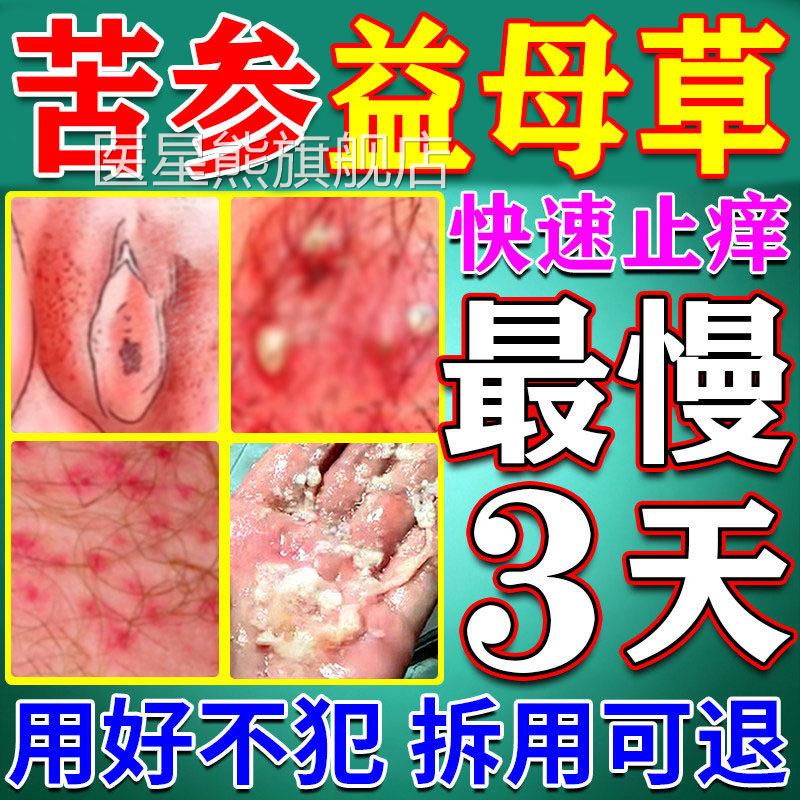 苦参益母草妇洁喷雾剂外阴瘙痒止专用膏药女私去抑菌处消阴道炎根