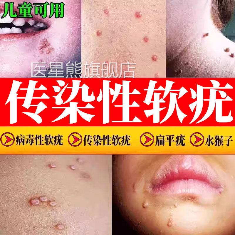 病毒性传染性软疣儿童水猴子药软尤医用镊子夹子刮勺房同售CA医星