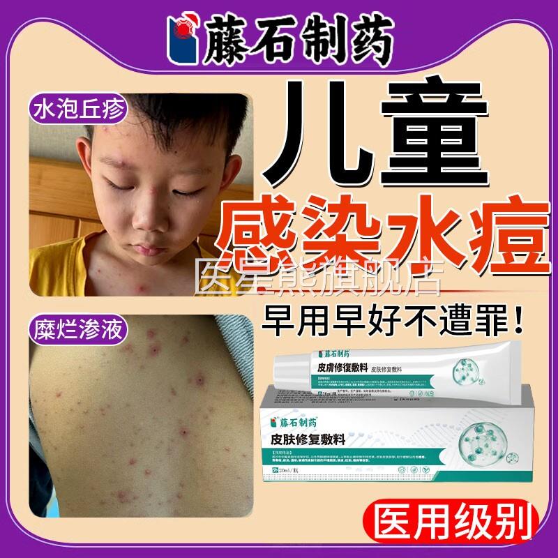 同儿童水痘药房售膏带状疱疹水泡专用水痘疤痕传染性外用止痒膏SK