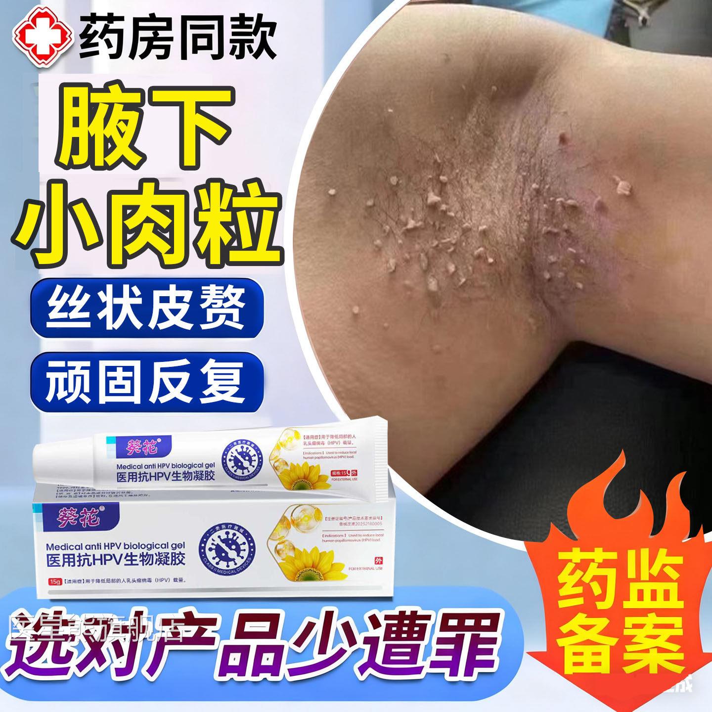丝状疣腋下小肉粒去除瘩神器专用疙皮赘膏去庞膏斩草除祛疣膏根TK