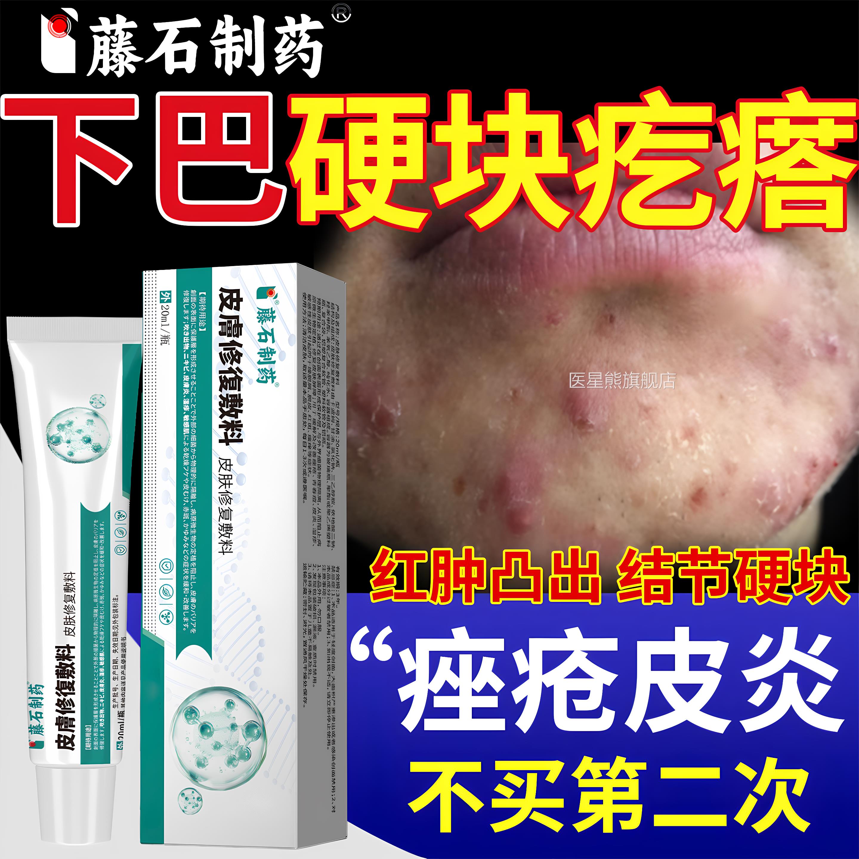 下巴痘反复长硬块痘痘疙瘩毛囊炎痤疮腮边淋巴闭口粉刺可搭药膏ZR