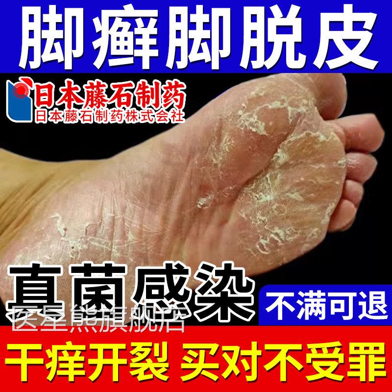 足脚癣一次净官方旗舰店皮脚气止痒裂脱真菌感染正品药监备案OM医