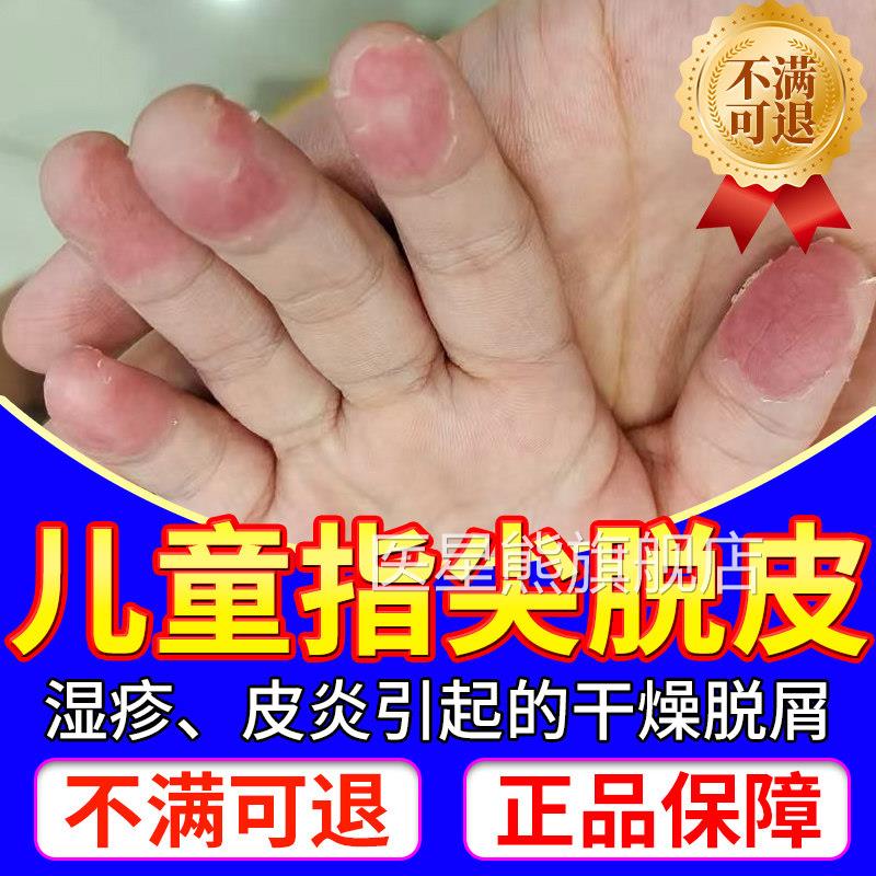 手指皮指尖专用儿童手癣膏脱皮干裂真菌感脱染严重蜕皮干燥起皮LL