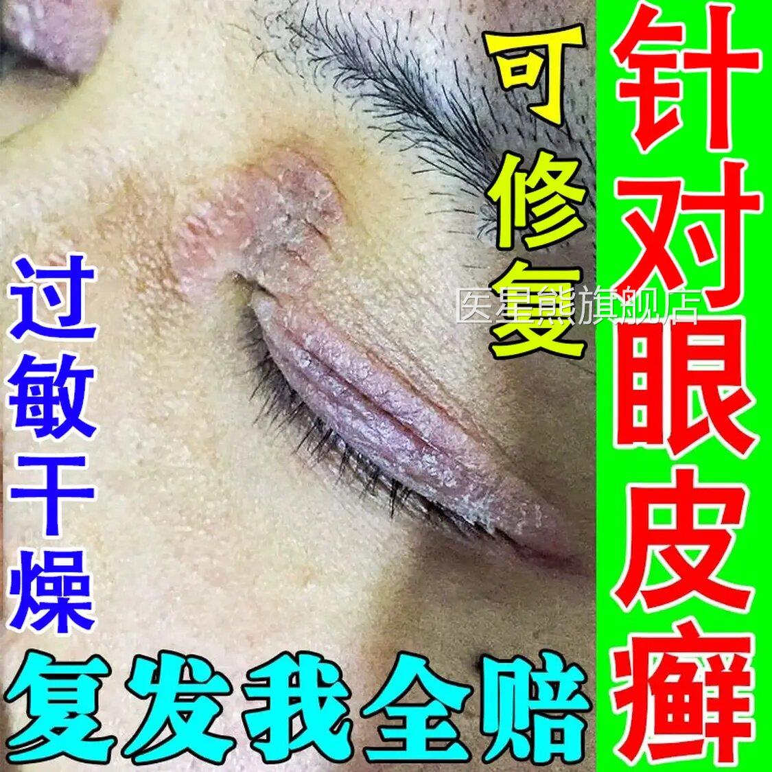 眼皮癣眼睛周红围眼角痒干燥起皮掉屑肿过敏保湿神经性皮炎专用膏