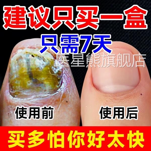 灰阿指甲修复液脱甲膏去莫搽剂除增厚药水正品官方旗舰店罗医星熊