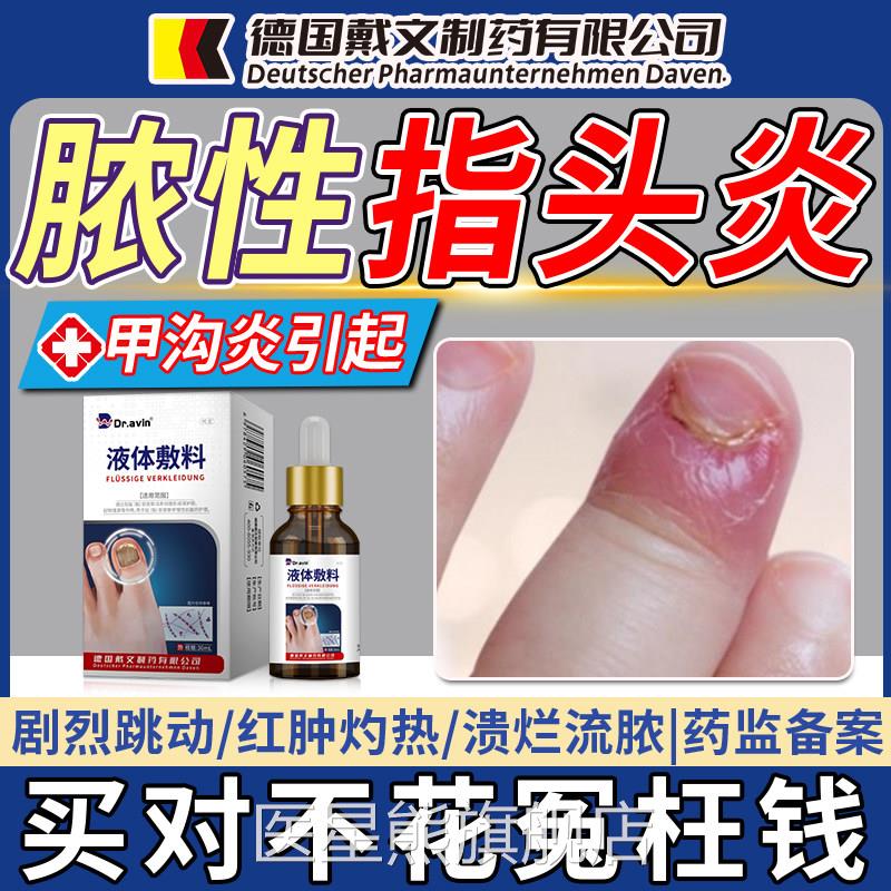 甲沟炎引起脓性指头甲炎手指化脓手指真菌感染消肿化脓药监备案OM