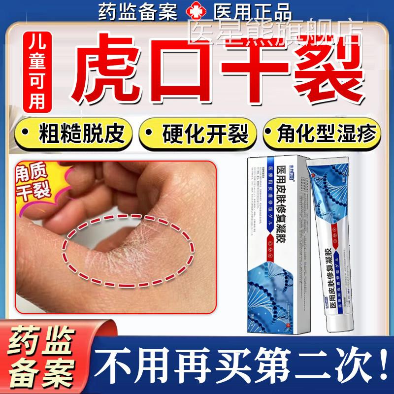 虎口手部角化型湿疹开裂手裂脱皮真菌感染干性皲裂干性手癣药膏TK
