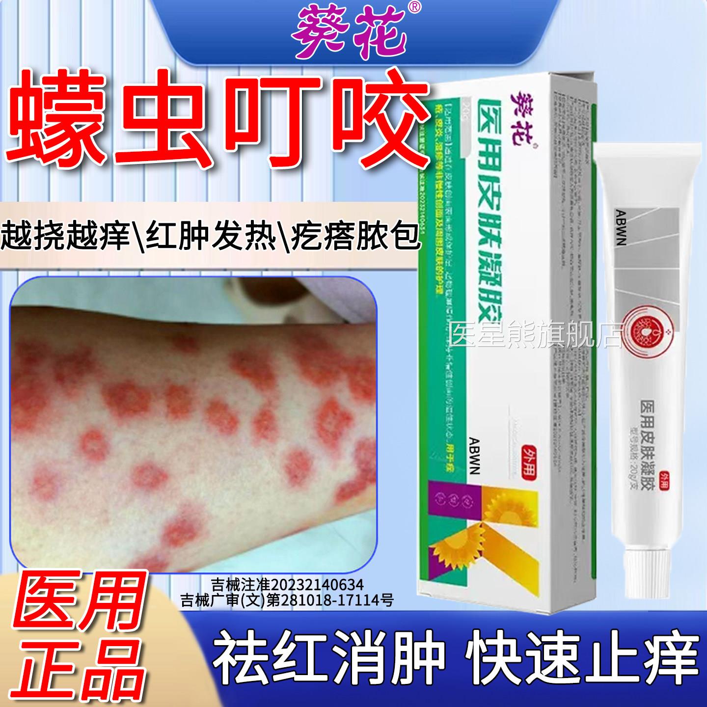 蠓虫咬伤止痒膏蚊毒虫叮咬皮炎消肿祛红斑瘙痒过敏水专泡药用克星