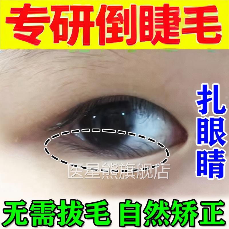 倒毛矫睫正贴成人婴儿睫毛倒长眼睑下垂提拉眼皮儿童专用神器正品