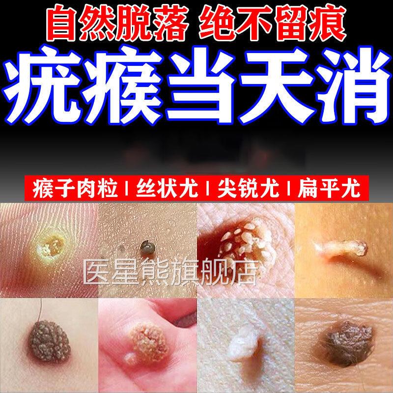 扁平疣软膏丝状疣疣瘊小肉粒疙瘩猴子非神器去除膏一灵抹去尤药膏