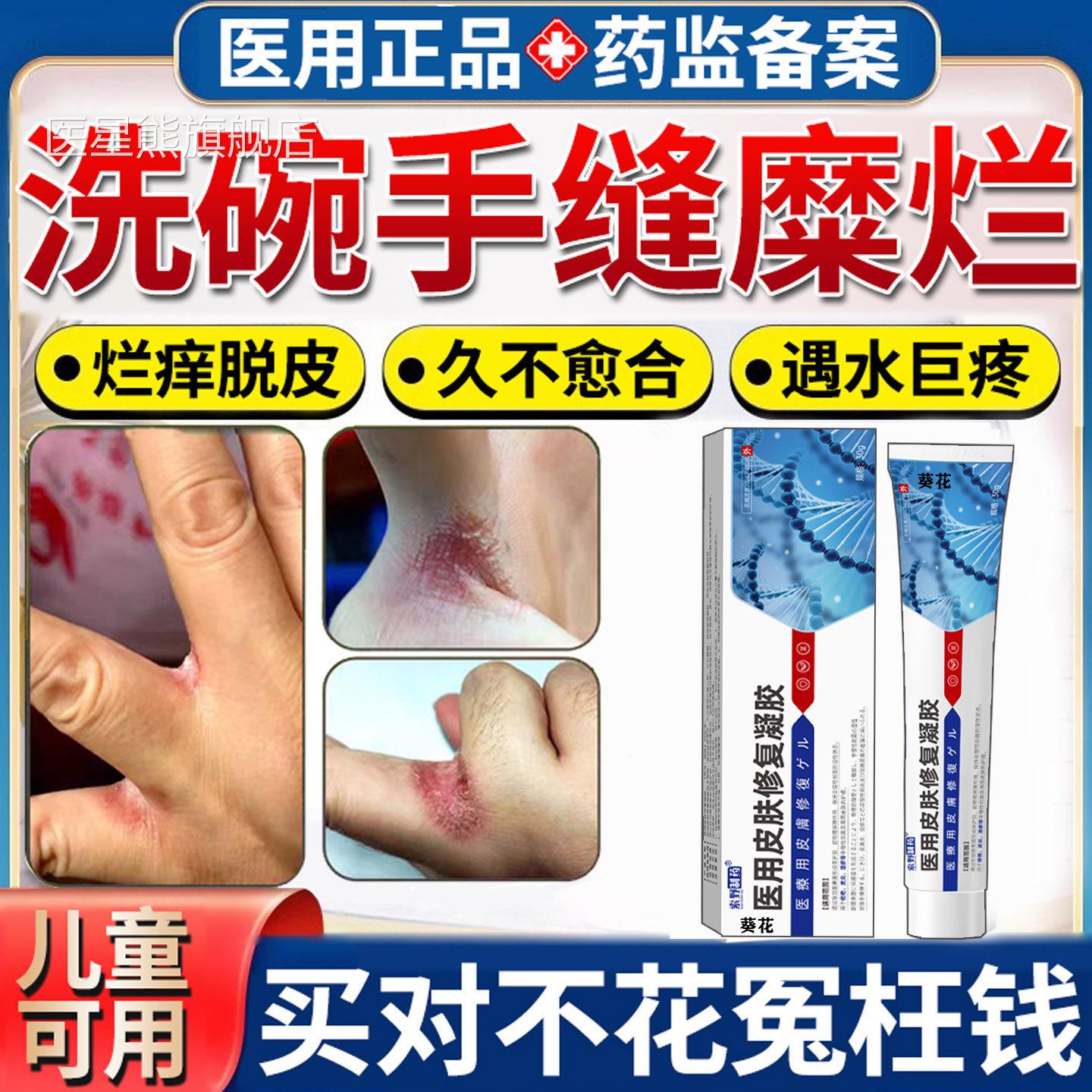 洗碰水手指缝溃烂药膏烂手丫糜烂痒碗水泡开裂脱皮湿疹软膏TK医星
