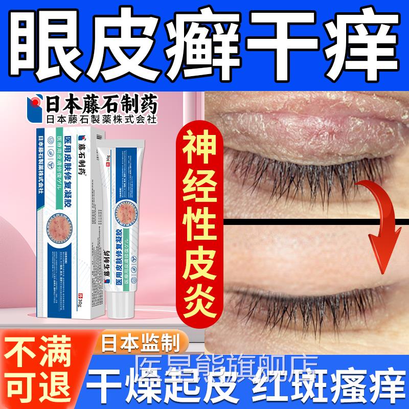 眼皮癣眼皮红肿眼睛周围过敏眼角发痒干燥起痒皮掉屑神经性皮炎HB