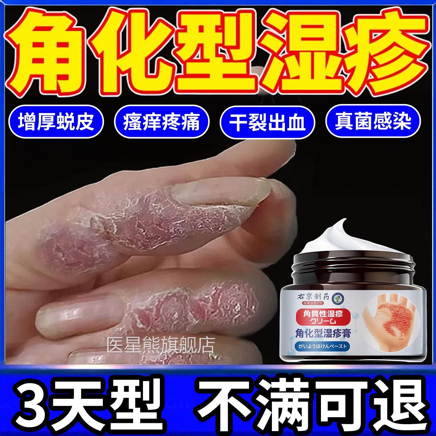 角化型湿疹手部脱皮干裂真菌感染痒专用手足癣去手止脚根部止痒膏