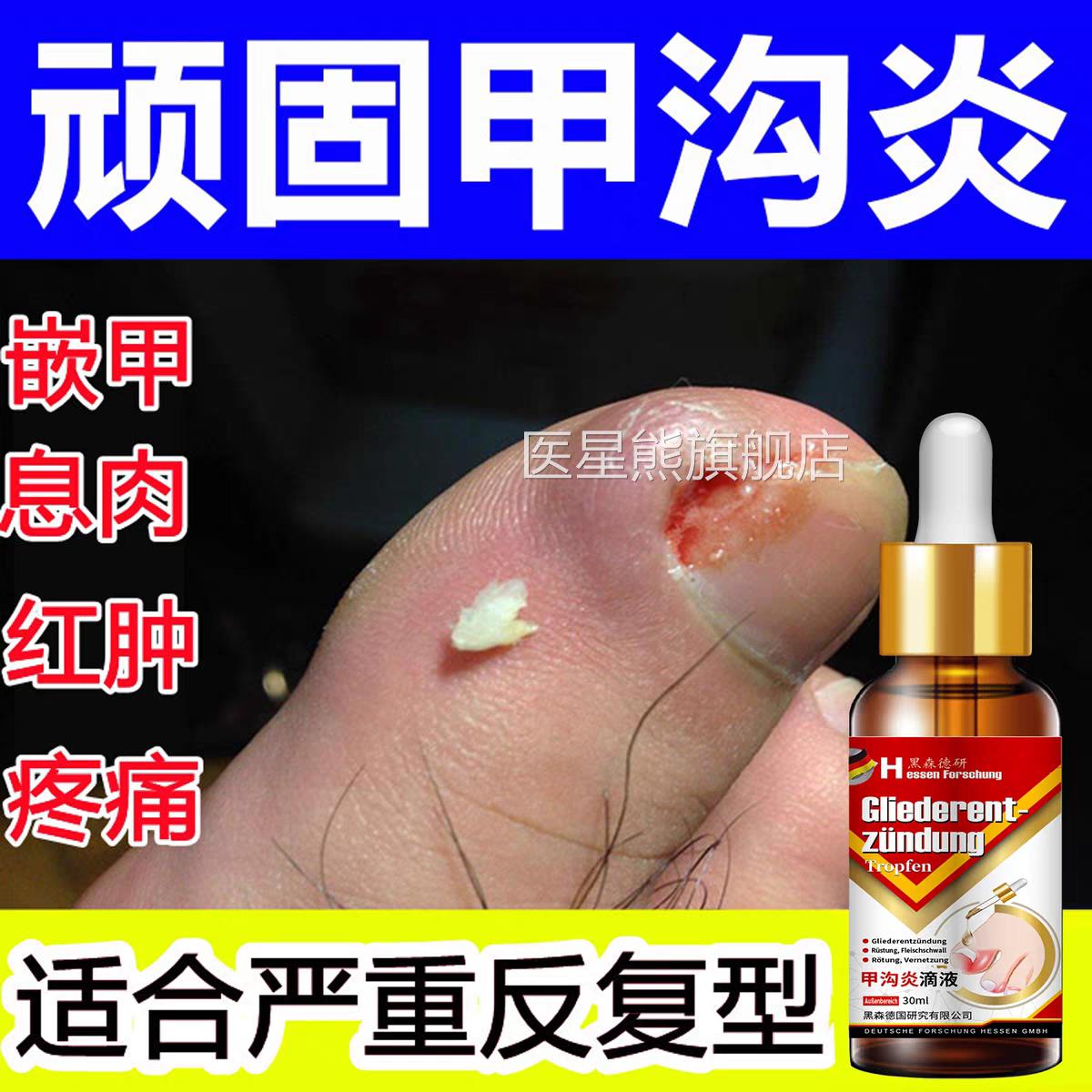 甲夹沟炎辅助治疗专用效特大药房器神脚趾根甲往肉里长手指膏嵌甲