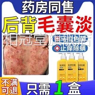 治后背长痘痘毛囊炎专用二硫化疗硒洗剂药膏马拉色菌特沐浴露效FF