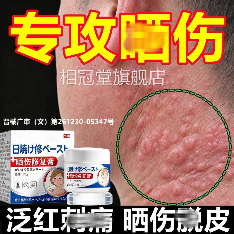 日光性皮炎紫外发线过敏晒伤修复膏太阳光晒伤专用皮肤痒乳膏正品