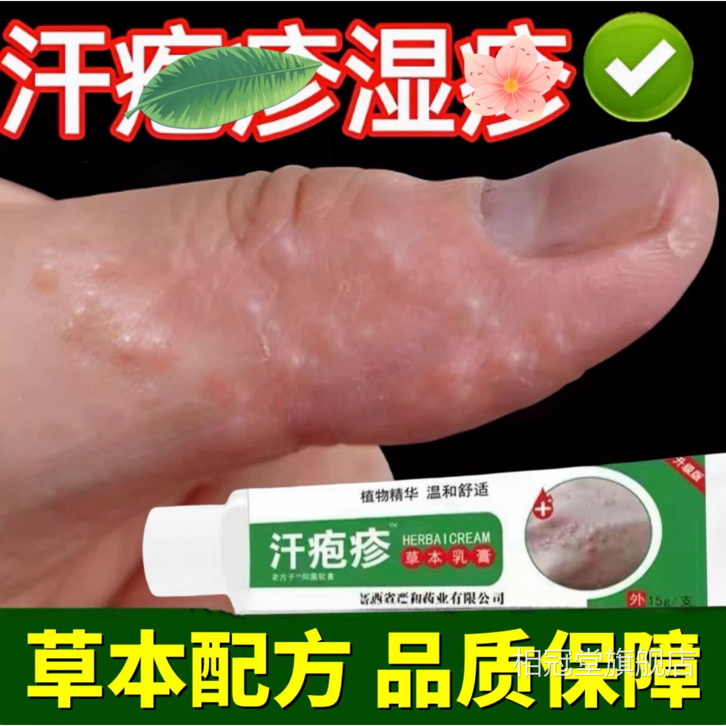 汗泡疱疹膏专手上起小水泡孢疹用真软膏汗状止菌痒感染汗泡疹膏15